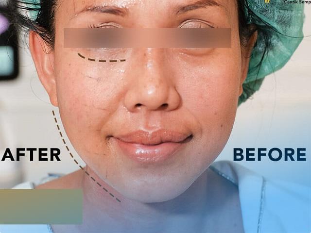 Premiera Skincare Klinik Kecantikan Semarang & Daftar Treatment Lengkap 1 Premiera Skincare Klinik Kecantikan Semarang