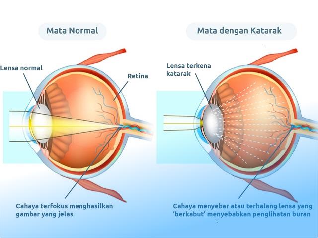 jakarta eye center bekasi